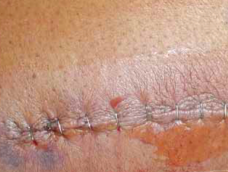 Knee-2days-Silverlon1.jpg